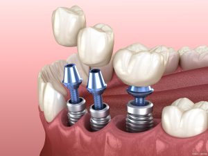 Łącznik implantu dentystycznego