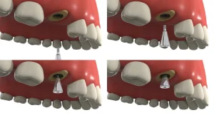 Pilares odontológicos