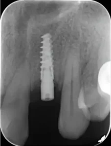 Implantes dentales Caso -2