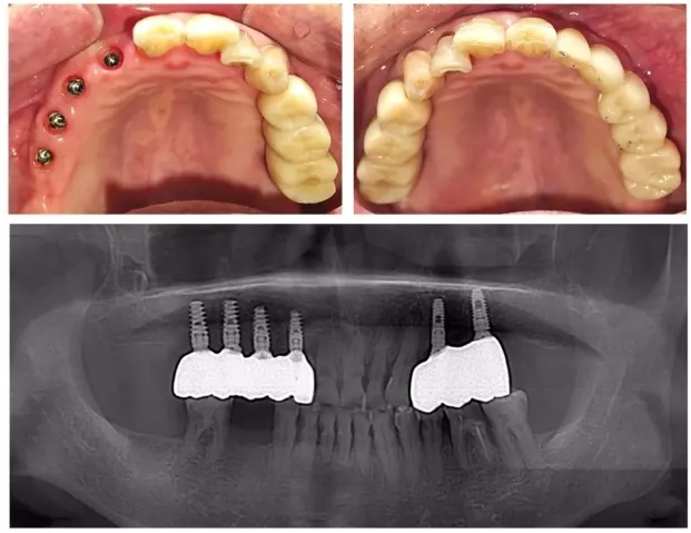 Um caso clínico de aumento ósseo em bloco horizontal na maxila com colocação simultânea de implantes para edentulismo parcial 9 Colocação da coroa definitiva concluída.