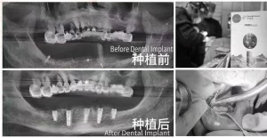Ventajas clínicas de los implantes DentalMaster Ultra-Hydrophilic en casos de media boca edéntula