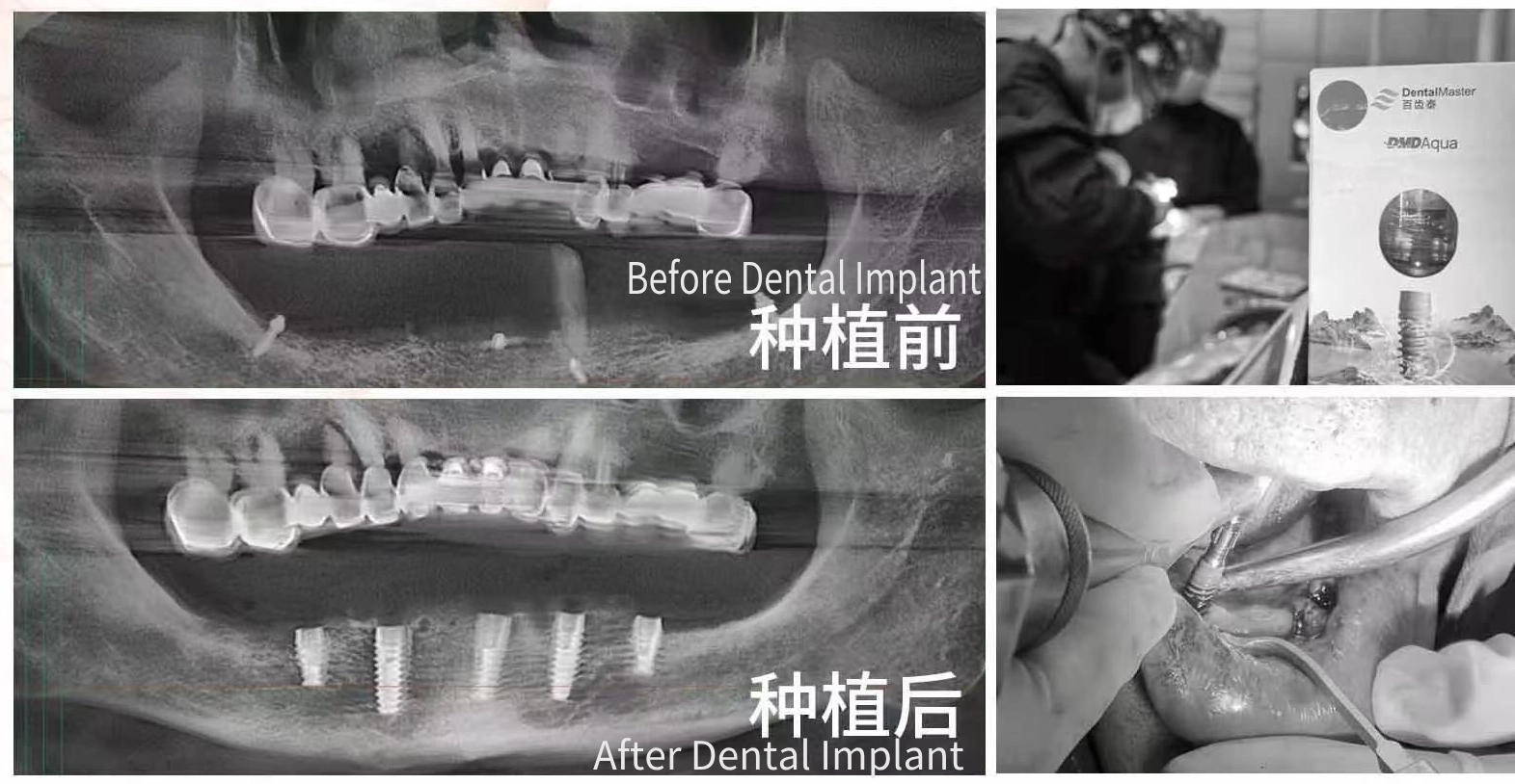 Клинические преимущества ультрагидрофильных имплантатов DentalMaster в случаях беззубой половины рта