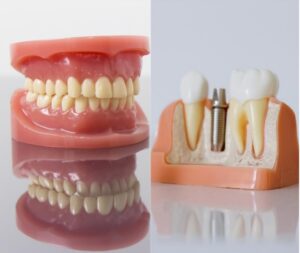 Which is Better, Dentures or Dental Implants?