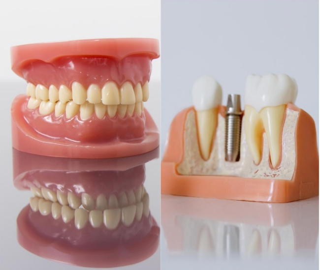 Which is Better, Dentures or Dental Implants?