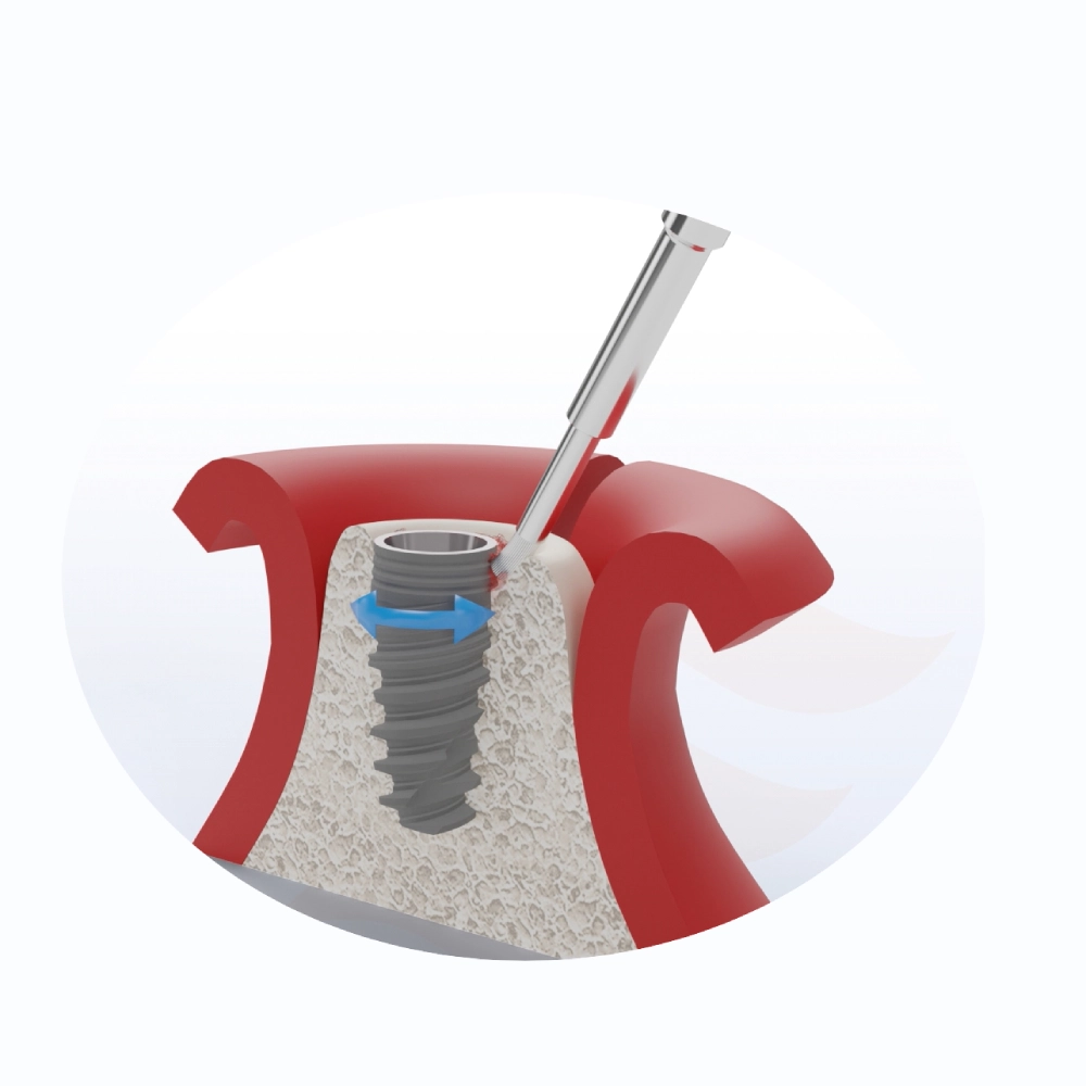 Hvordan renser man peri-implantitis? - 新建项目 1
