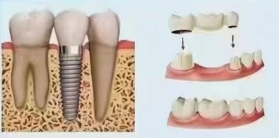 Dental Implant vs Bridge