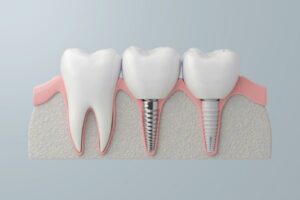 Titanium vs Ceramic dental implants