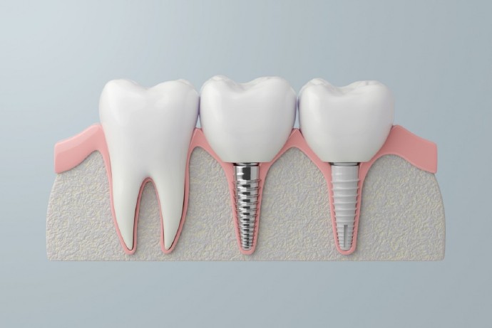 Titanium vs Ceramic dental implants