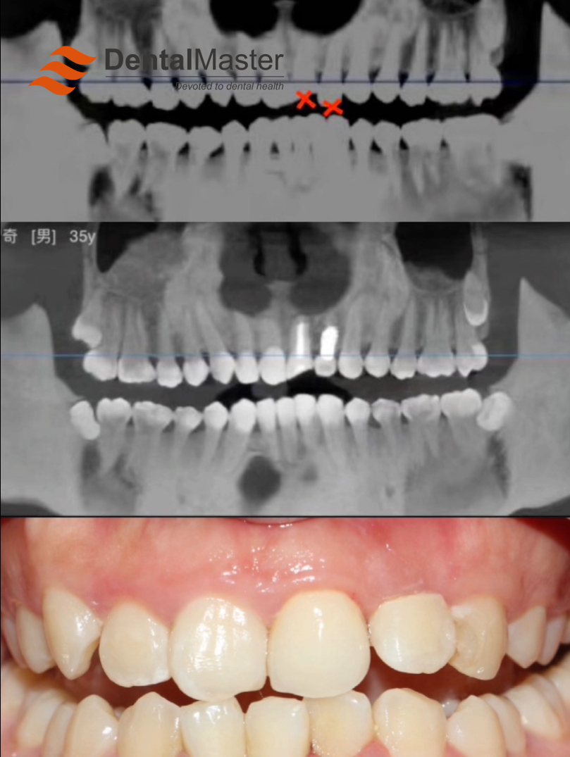 Immediate Implants