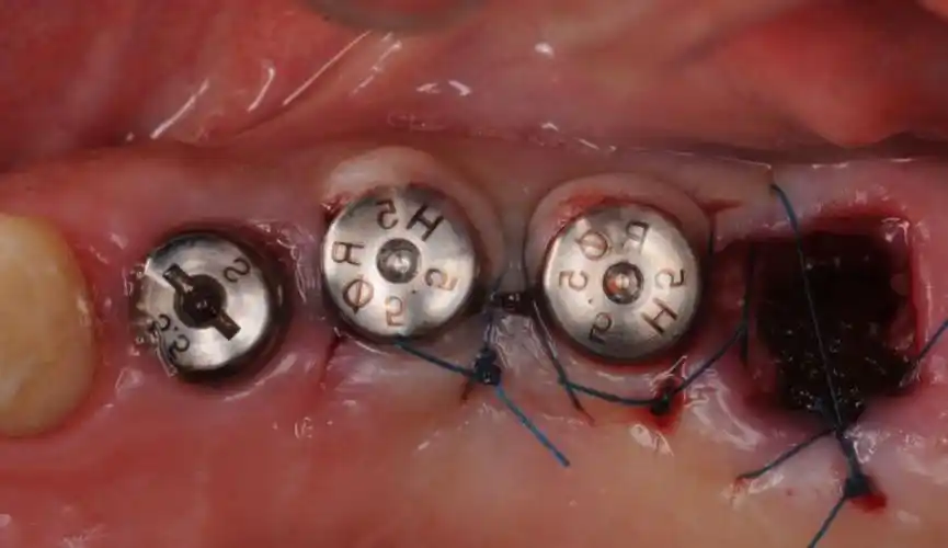 healing abutment for dental implant