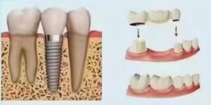 Dental Implant vs Bridge