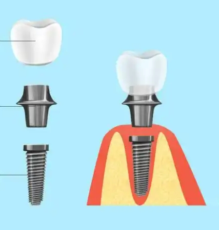 Application of Titanium and Titanium Alloys in Dentistry - 20250604120512