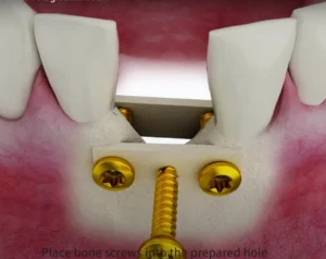 Bone Tacks, Grafts & Screws in Dental Implants: What You Need to Know in 2025