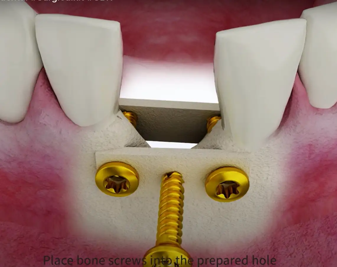 Bone Tacks, Grafts & Screws in Dental Implants: What You Need to Know in 2025